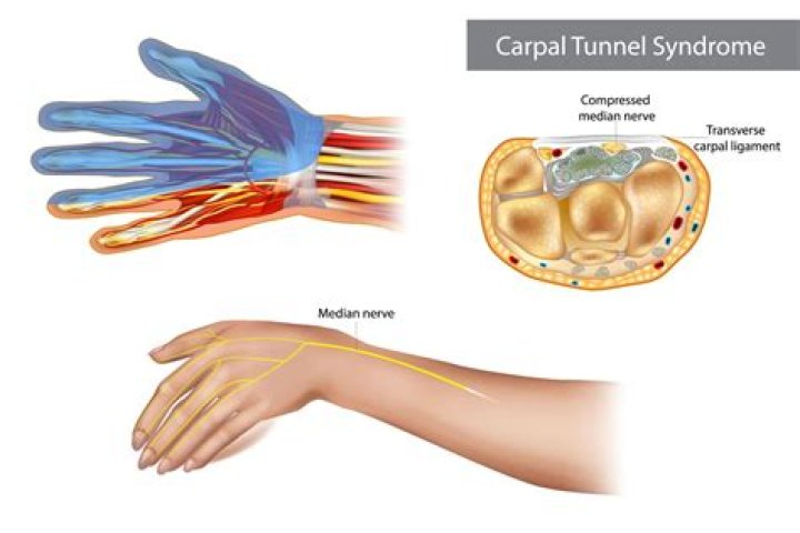 Does carpal tunnel qualify you for disability?
