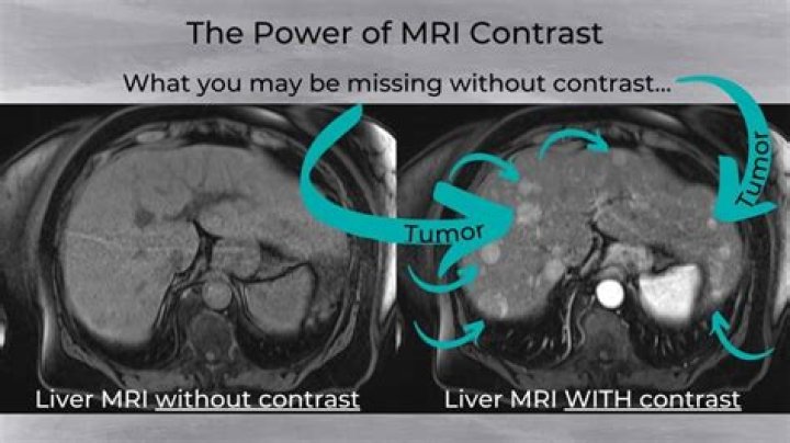Does MRI contrast affect liver?