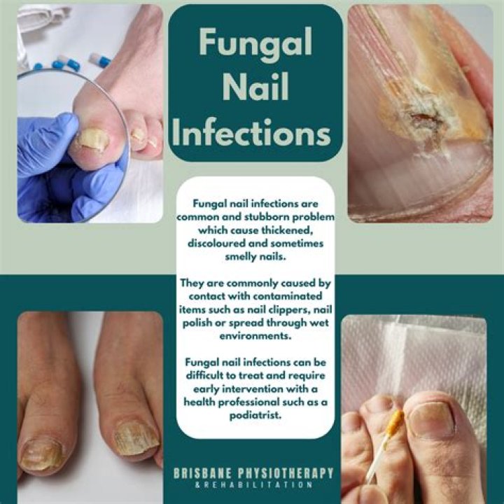 How can you tell if you have a fungal infection in your lungs?