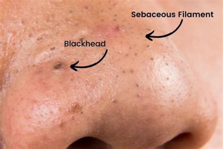 Is it normal to get blackheads on your breasts?