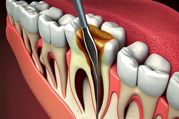 Is tooth nerve removal painful?