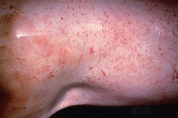 What does mange look like on a human?