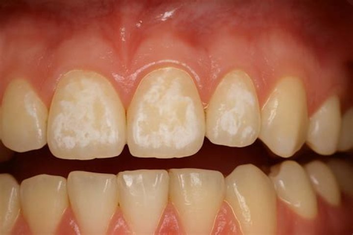 What is pathology decalcification?