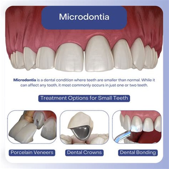 What tooth is most likely to be affected by microdontia?